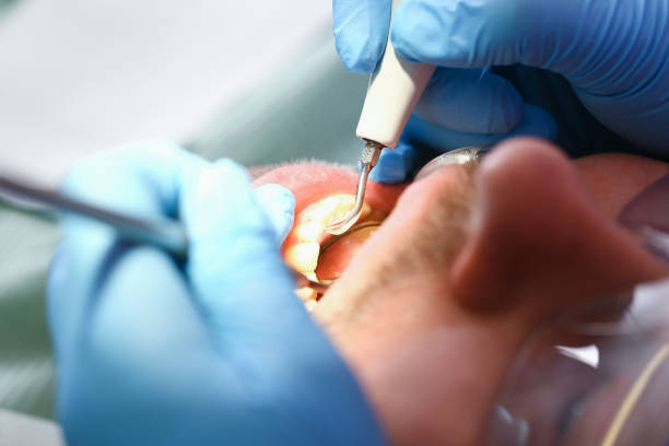 Best Emergency Tooth Extraction in Eagan, MN